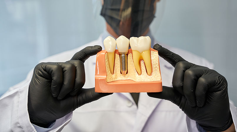 Quais os Tipos de Implante Dentário?