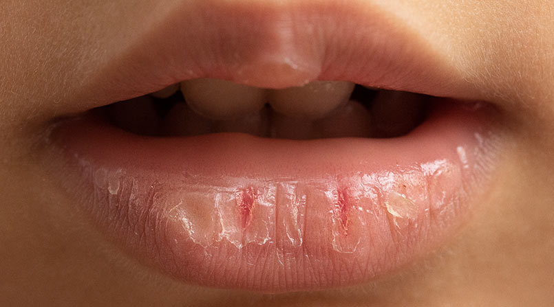 Boca Seca: O Que Pode Ser, Causas, Sintomas e Como Tratar